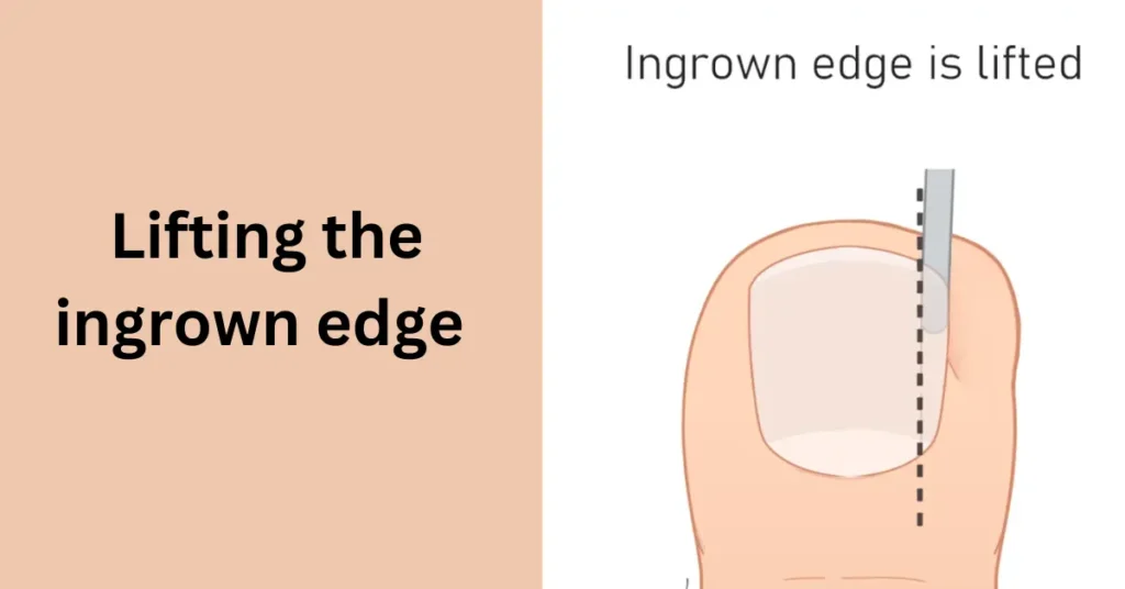  Lifting the ingrown edge