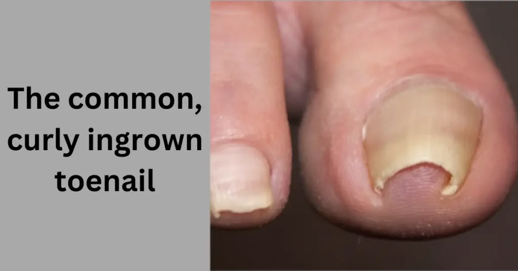 The common, curly ingrown toenail