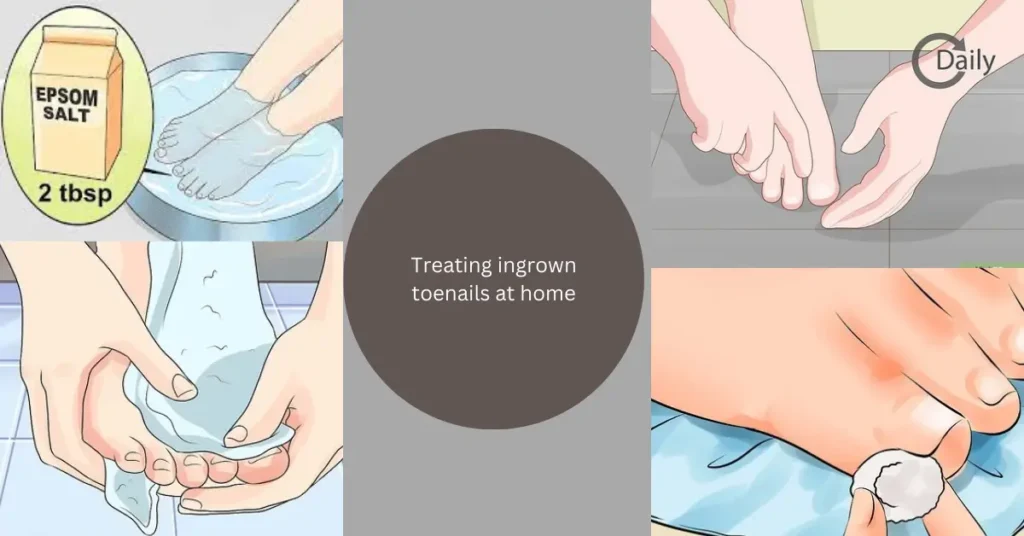 Treating ingrown toenails at home