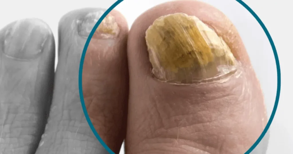 WHY DO TOENAILS GET THICK WITH AGE?