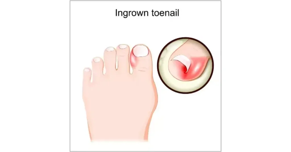 What is an Ingrown Toenail?