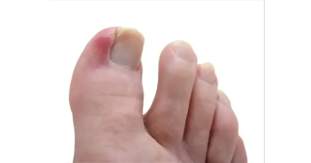 What Is An Ingrown Toenail? Its Symptoms, Causes, Diagnosis And Treatment