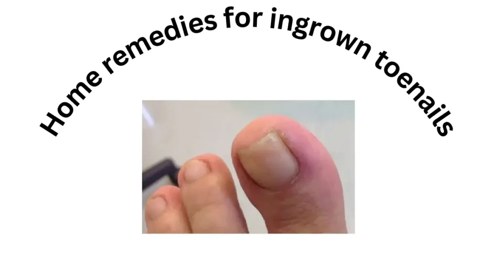 Home remedies for ingrown toenails