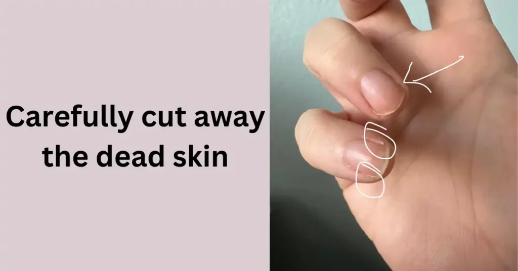 Carefully cut away the dead skin