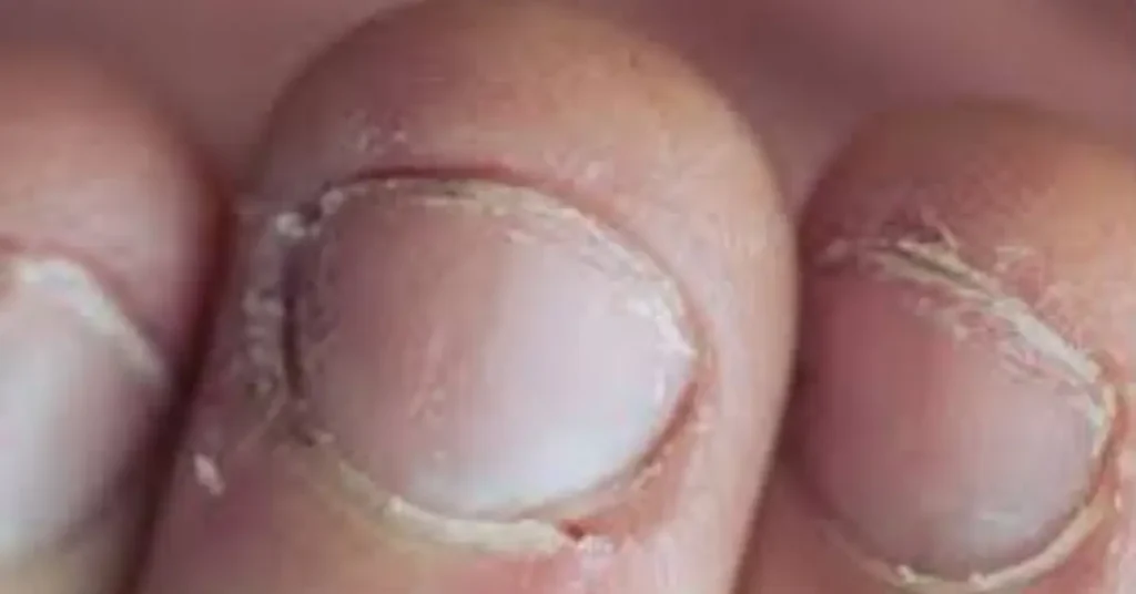 Dry, cracked cuticles