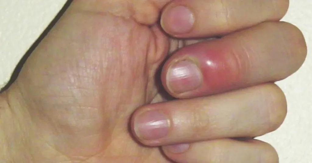 Infected cuticles