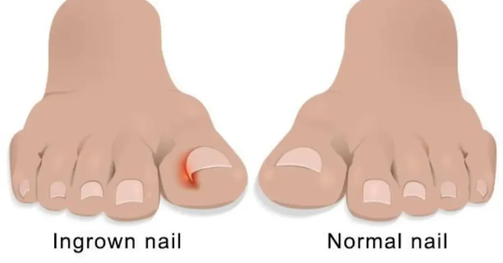 What causes ingrown toenails? A guide to prevent and treat at-home