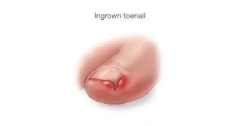 What Is an Ingrown Nail?