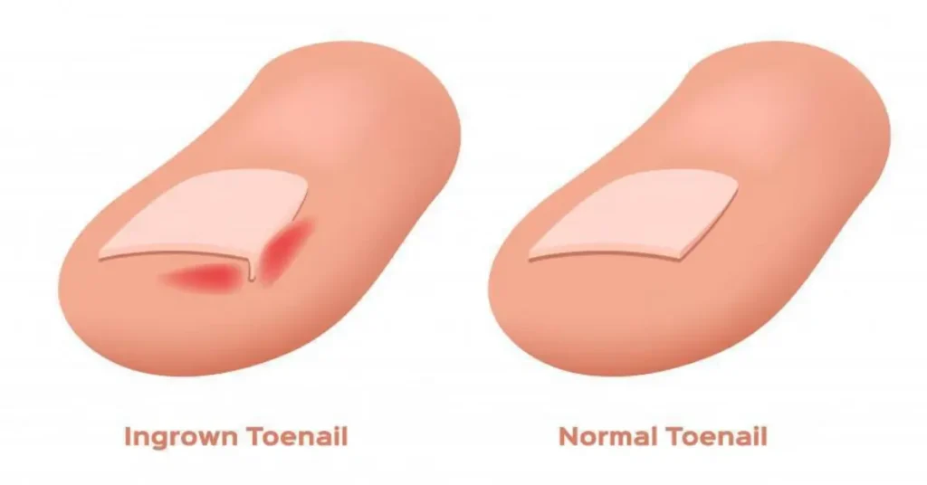 What Are the Symptoms of an Ingrown Nail?